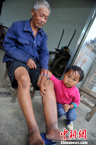 抗戰(zhàn)勝利69周年:探訪江西萬家?guī)X戰(zhàn)役毒氣受害老人